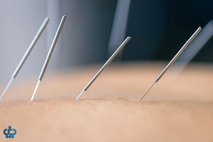 طب سوزنی (Acupuncture) و ماساژ درمانی